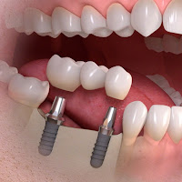 Độ tuổi cấy ghép implant an toàn nhất