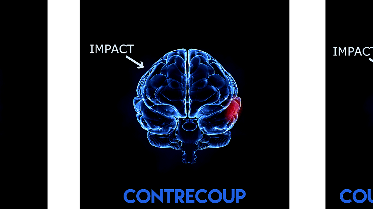 Coup contrecoup injury Injury Choices