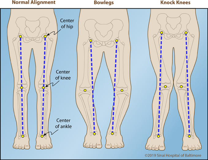 Este posibilă vindecarea artrozei deformante a articulației genunchiului)