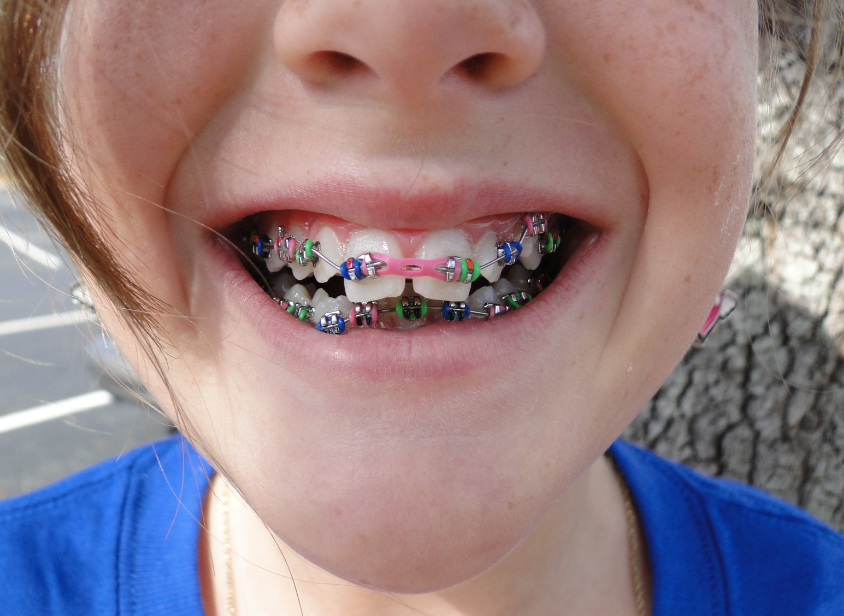 Fairfax Gallants CHLOE GETS BRACES!