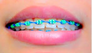 9 Cara Menjaga Behel atau pengguna kawat gigi
