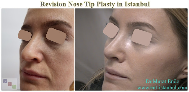 Revision Aesthetic Nose Tip Surgery, Revision Nose Tip Plasty in Istanbul,