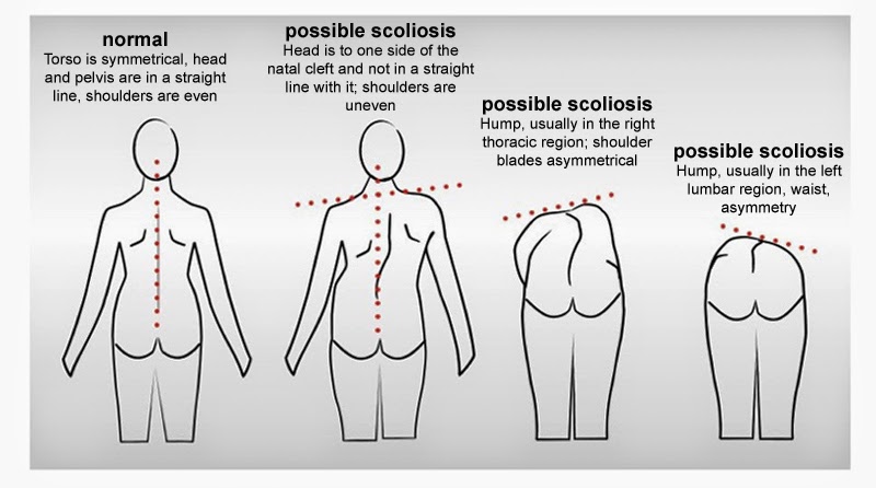 SCOLIOSIS treatment