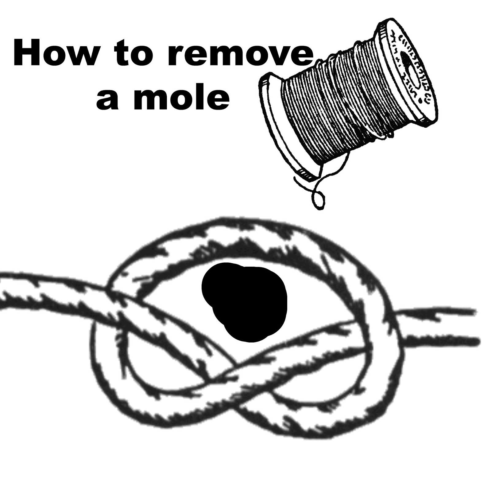 How to remove a mole yourself!