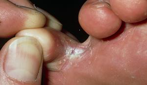 Athlete’s Foot (Tinea Pedis) and Fungal Infections Athlete's foot is a rash caused by a fungus that usually appears between the toes