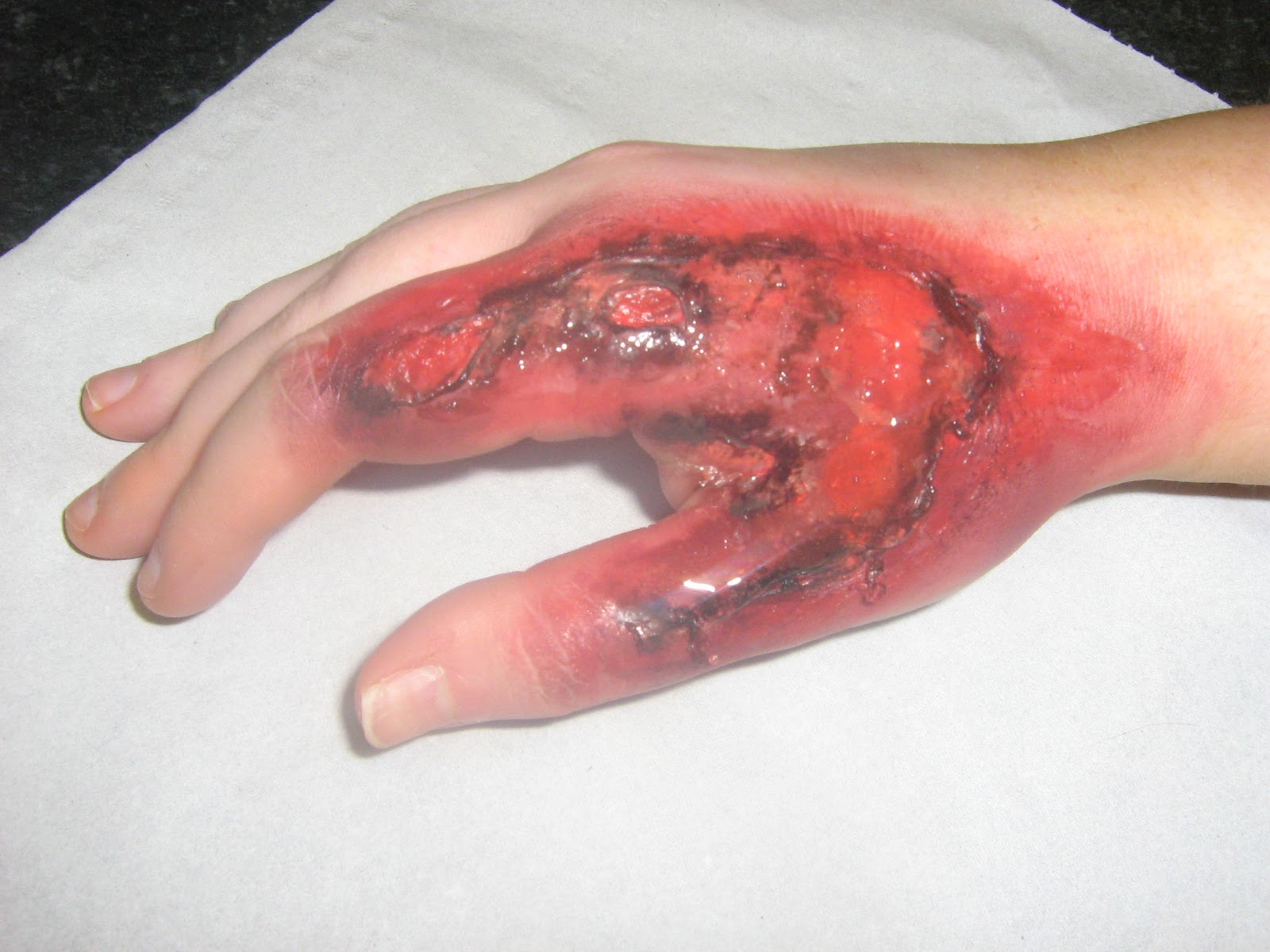 what are the worst kinds of burns