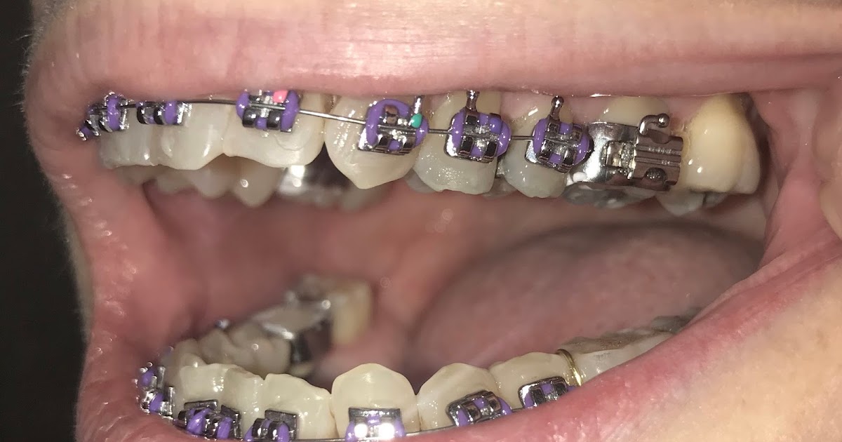 Sarah Says... Day 15, 3 molar bands and metal spacers