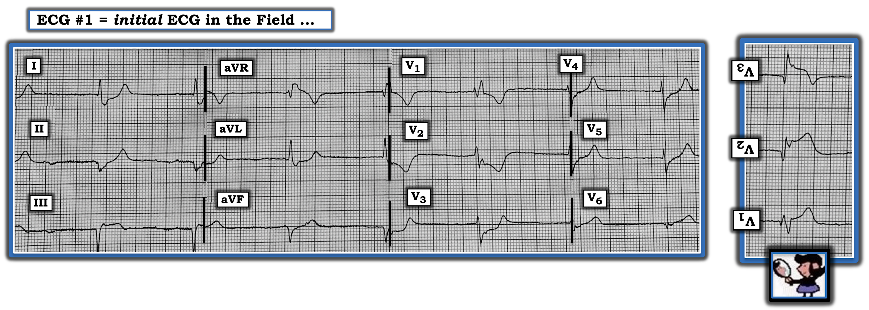 Dr. Smith's ECG Blog "It isn't a STEMI," so cath lab refusal (again