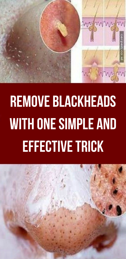 Let Start Slim Today Remove Blackheads With One Simple And Effective Trick