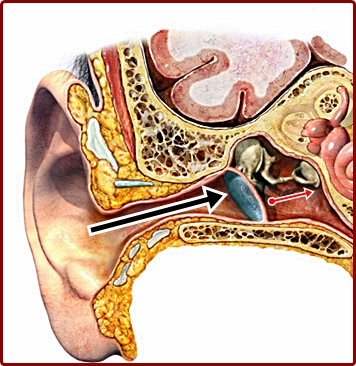 The Stapes in Otosclerosis: Osteoarthritis of an Ear Ossicle