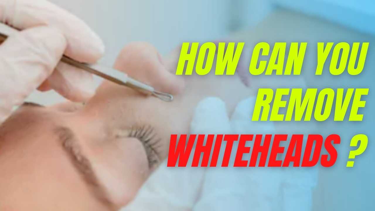 whiteheads-causes-how-to-get-rid-of-whiteheads-naturally-2020