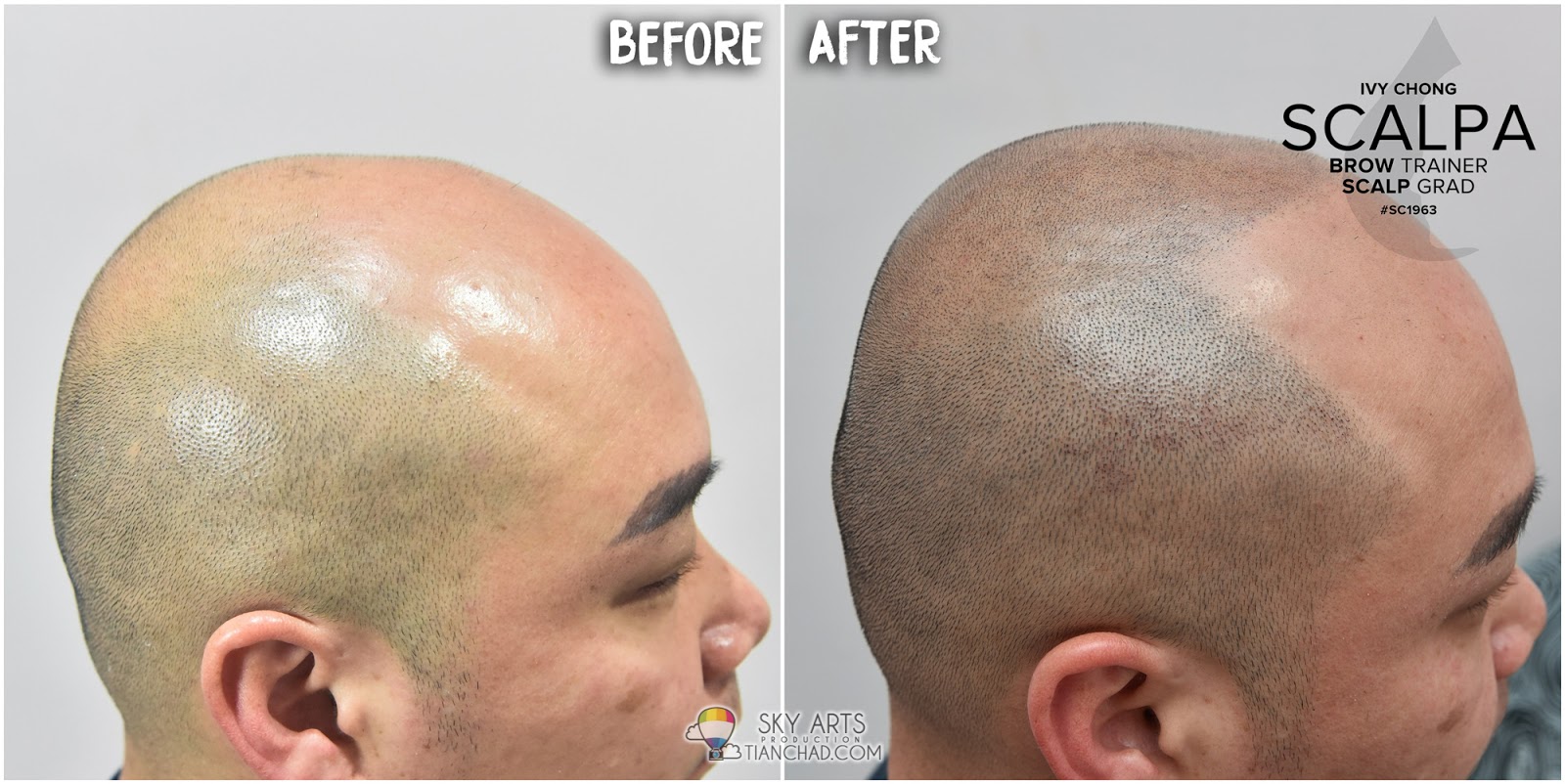 Best Scalp Micropigmentation (SMP) in Malaysia SMP 让你不再为秃头而烦恼