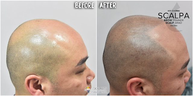 BEFORE and AFTER look of the scalp after TWO session of Scalp Micropigmentation (SMP) treatment 