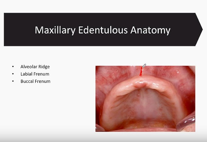 PROSTHODONTICS: Maxillary Edentulous Anatomy