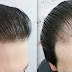 Types of operation hair transplantation and the latest ones Types of operation hair transplantation and the latest ones