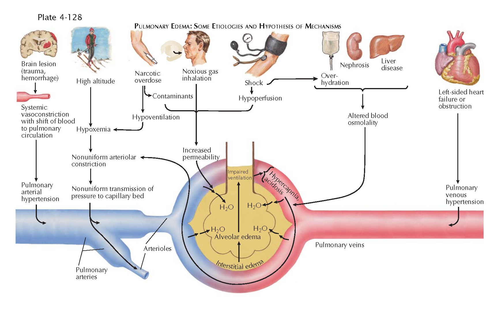 Pulmonary Edema Pathophysiology Vrogue co pulmonary-edema-pathophysiology-vrogue-co