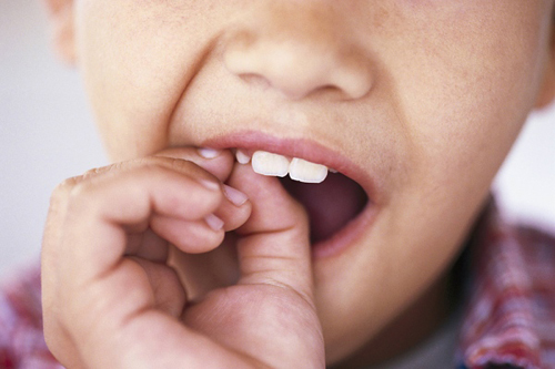 Có nên nhổ răng sữa cho trẻ hay không?