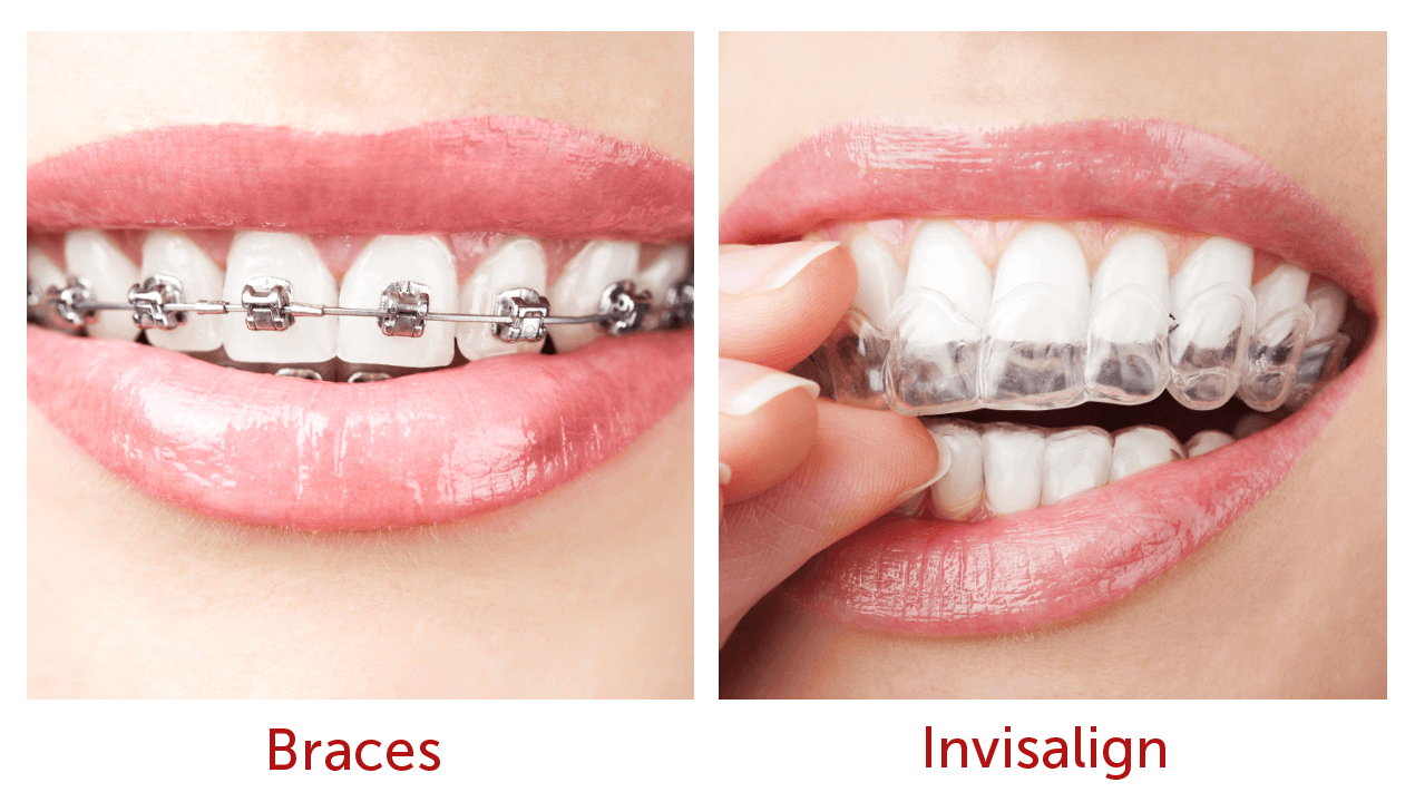 What Are The Basic Differences Between Dental Braces and Invisalign?