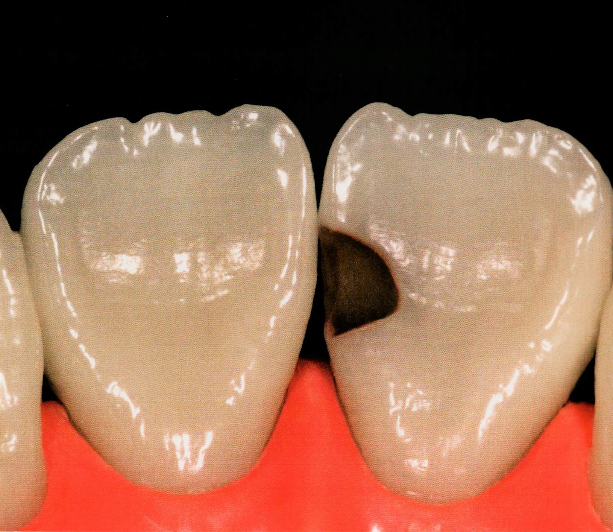 Class III composite restoration " Palatal access " Dental Esthetics