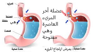 ارتجاع المريء