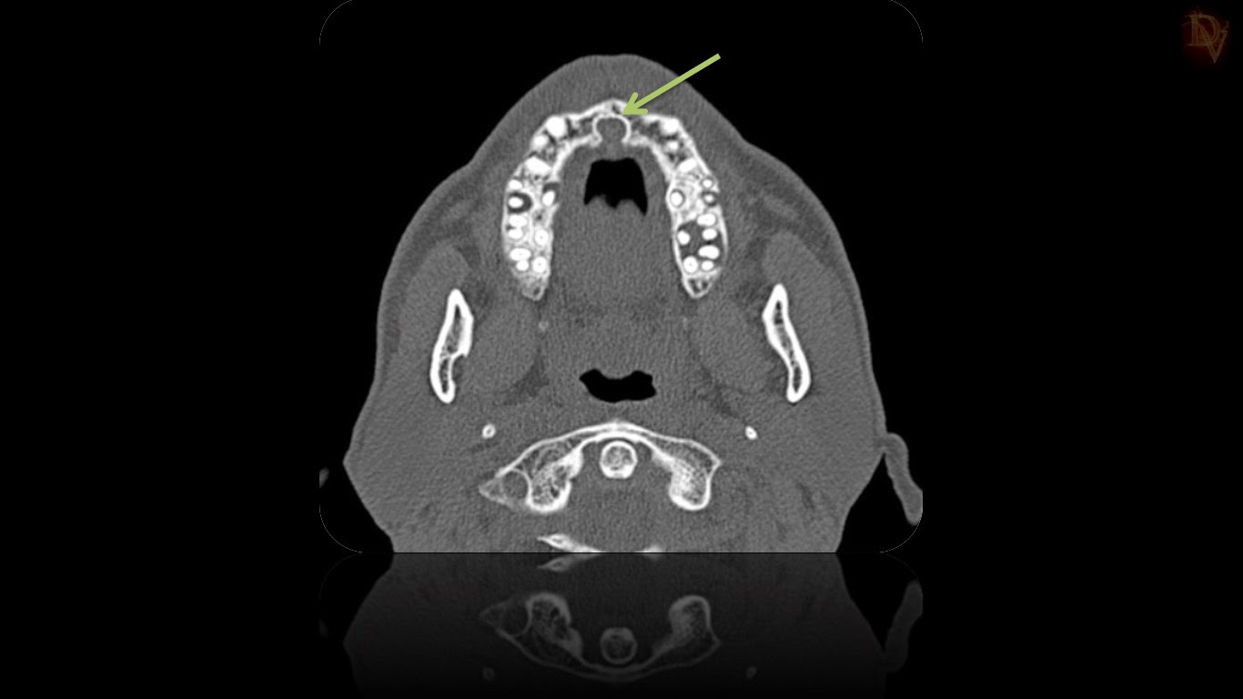 Ultimate Radiology Incisive Canal Cyst (Nasopalatine Duct Cyst)