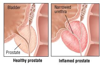 A férfiakban a prostatitis)