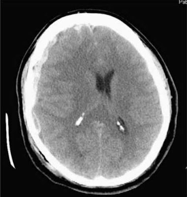 brain CT demonstrates