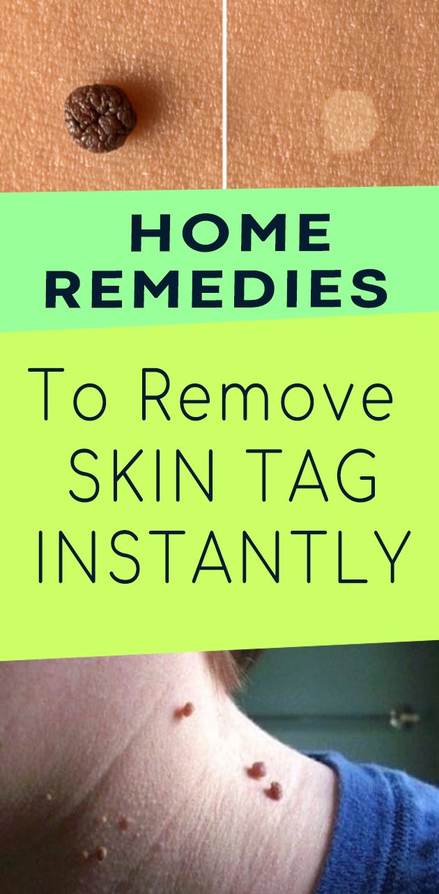 Top 10 Home Remedies To Remove Skin Tags Naturally healthy Glowing