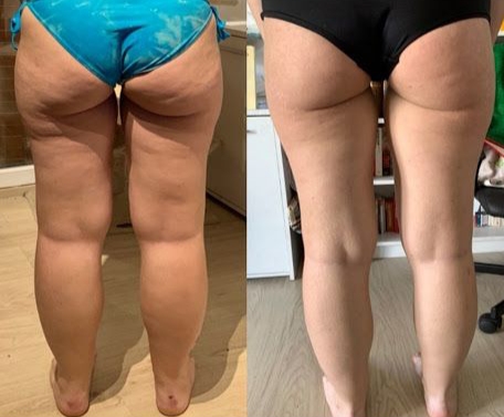 Cellulite et varices aux jambes? éliminer les deux avec l'alcool de romarin!