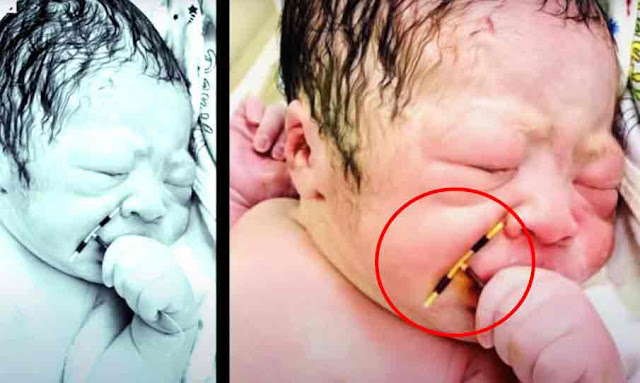 Baby ‘born holding mum’s contraceptive IUD that failed to stop her getting pregnant’