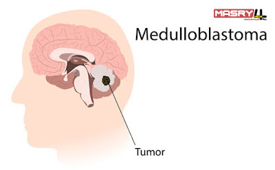 الورم الأرومي النخاعي ، الأسباب والأعراض والعلاج Medulloblastoma - Causes, Symptoms & Treatment