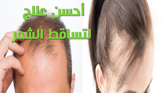 علاج تساقط الشعر بطرق طبيعية 