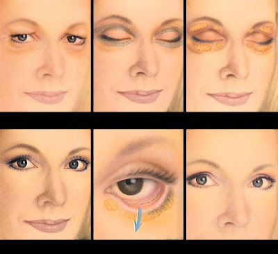 eye lid surgery before and after photos