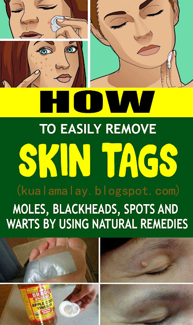 HOW TO EASILY REMOVE SKIN TAGS, MOLES, BLACKHEADS, SPOTS ...