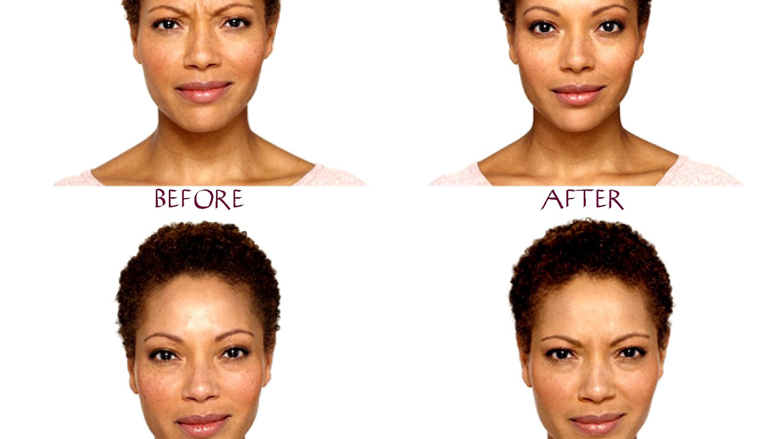 How Long For Botox To Take Effect Effect Choices