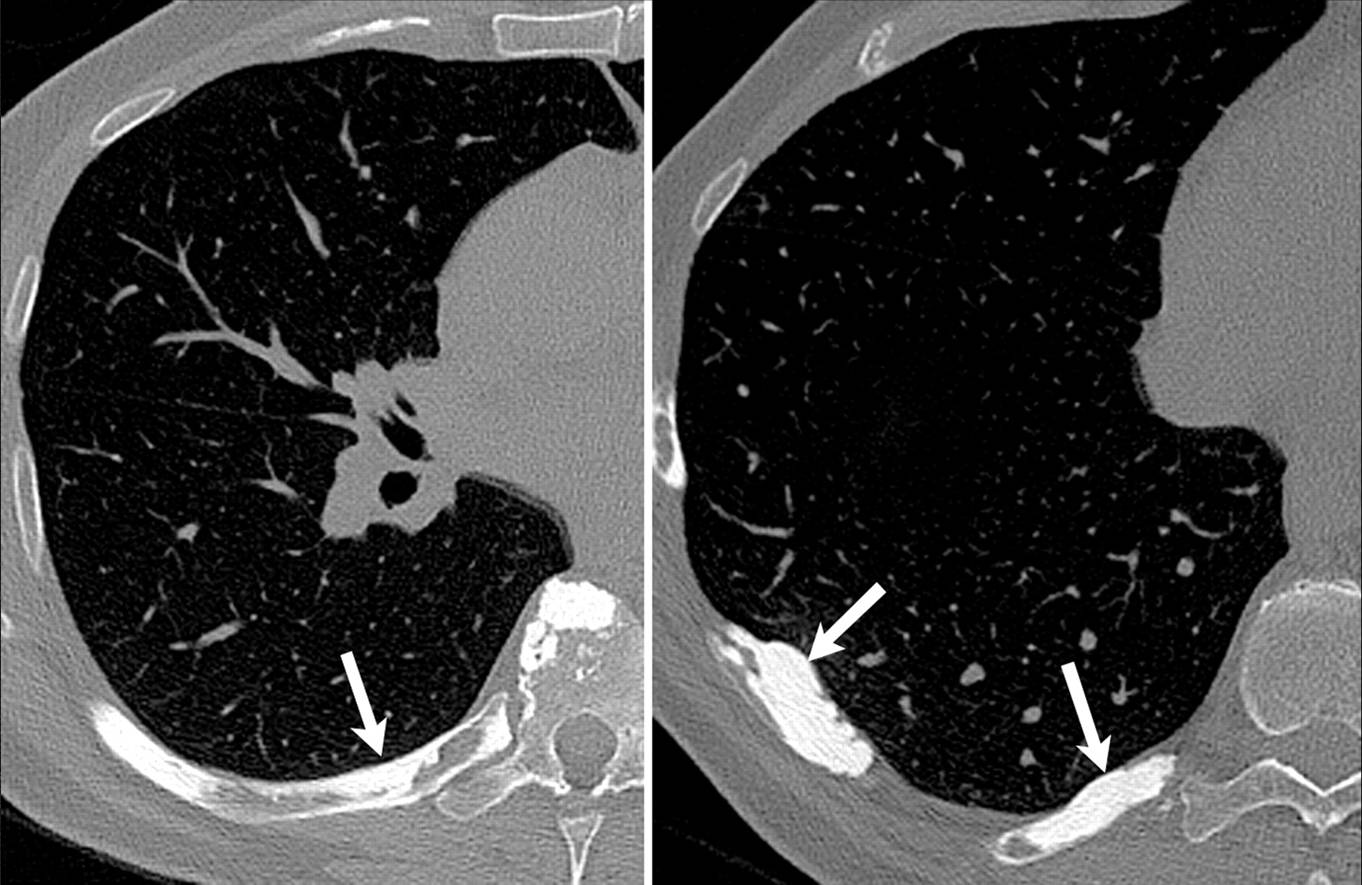 ABC Radiology Blog The Dripping Candle Wax Sign