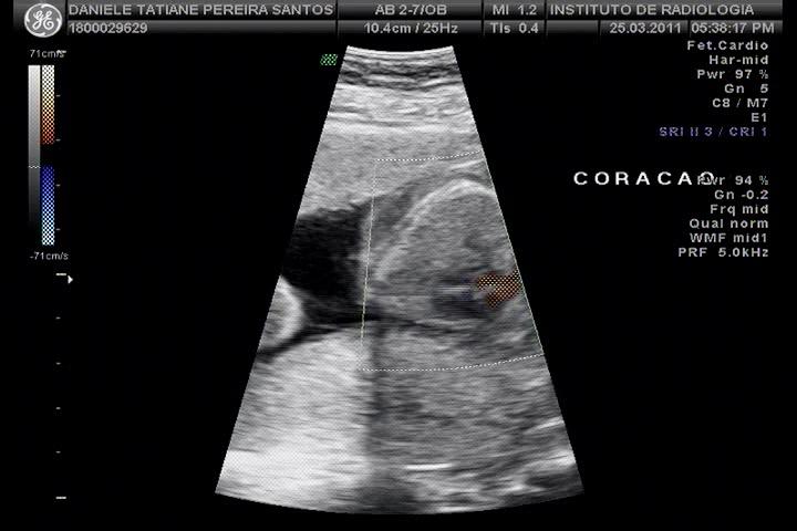 Grávidos da Lorena Beatriz: Fotos do Ultrassom de 5 meses