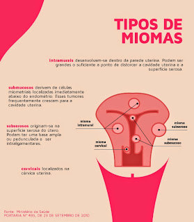 Miomas uterinos