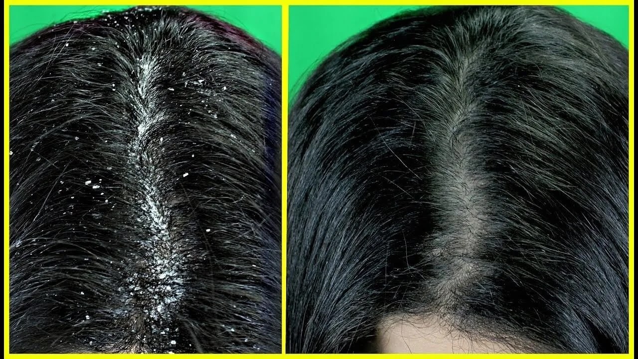 التخلص من قشرة الشعر بزيت الزيتون التخلص من قشرة الشعر بزيت الزيتون