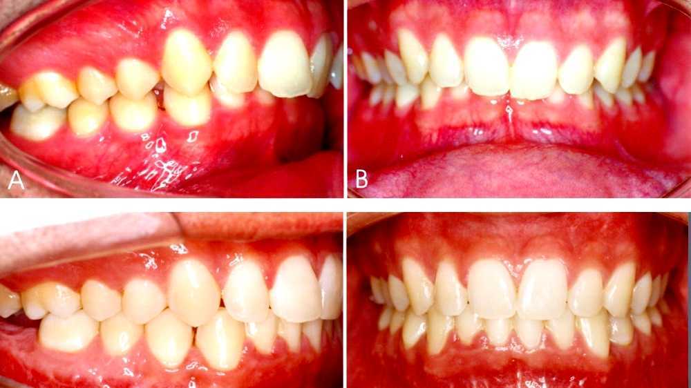 Occlusion (dentistry)