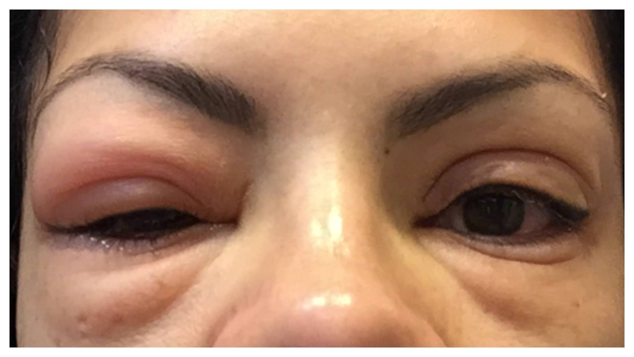 Eyelashes LongTerm Effects Of Eyelash Extensions