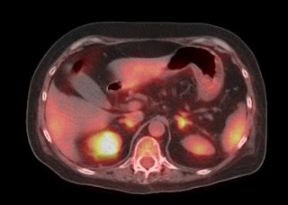 NuCleaR MuNkeE: Adrenal Hyperplasia and PET/CT