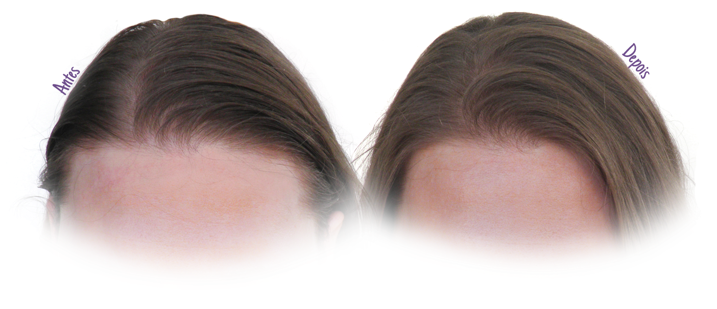 Chá De Camomila Cabelo Antes E Depois