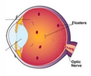 Floaters And Flashes - by Eye Care Hospital