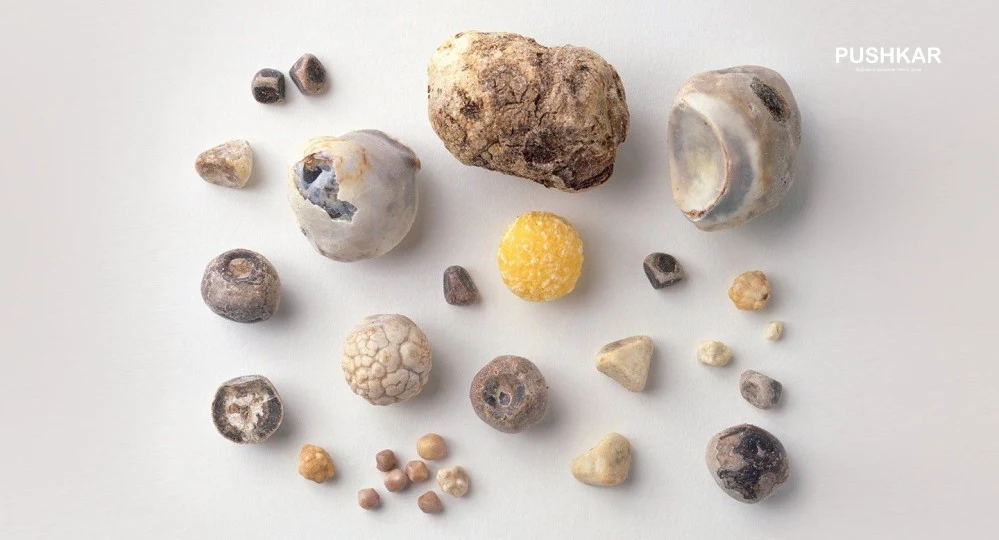 ЖЕЛЧНЫЕ КАМНИ (КАМНИ В ЖЕЛЧНОМ ПУЗЫРЕ) - ЖЕЛЧНОКАМЕННАЯ БОЛЕЗНЬ (ЖКБ) ИЛИ ХОЛЕЛИТИАЗ.