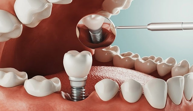 durable dental implants