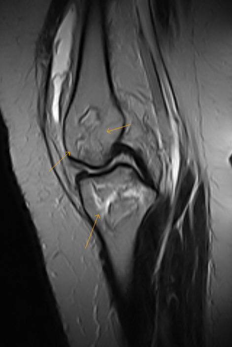 Knee Avascular Necrosis Mri Sumers Radiology Blog