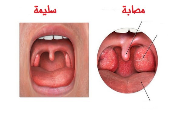 علاج التهاب اللوزتين عند الأطفال