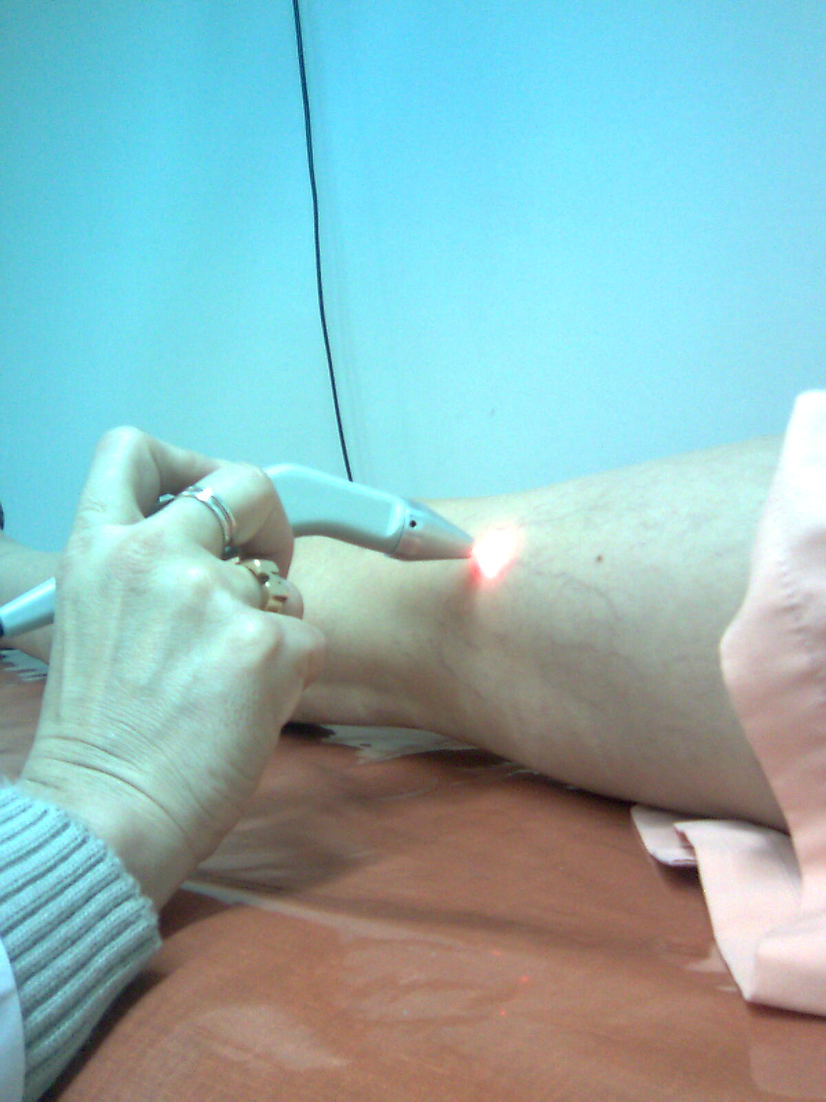Tratamiento laser para varices en cordoba