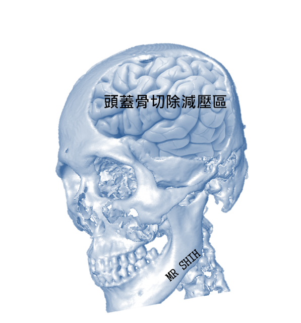 Mr Shih 施育彤醫師 3d列印作的頭蓋骨